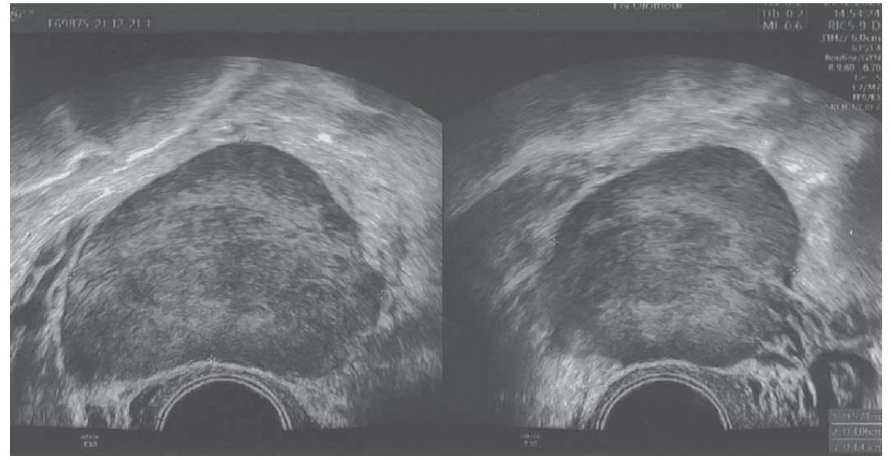 a-patient-with-primary-adenocarcinoma-of-the-appen-prol-ka-e-cz