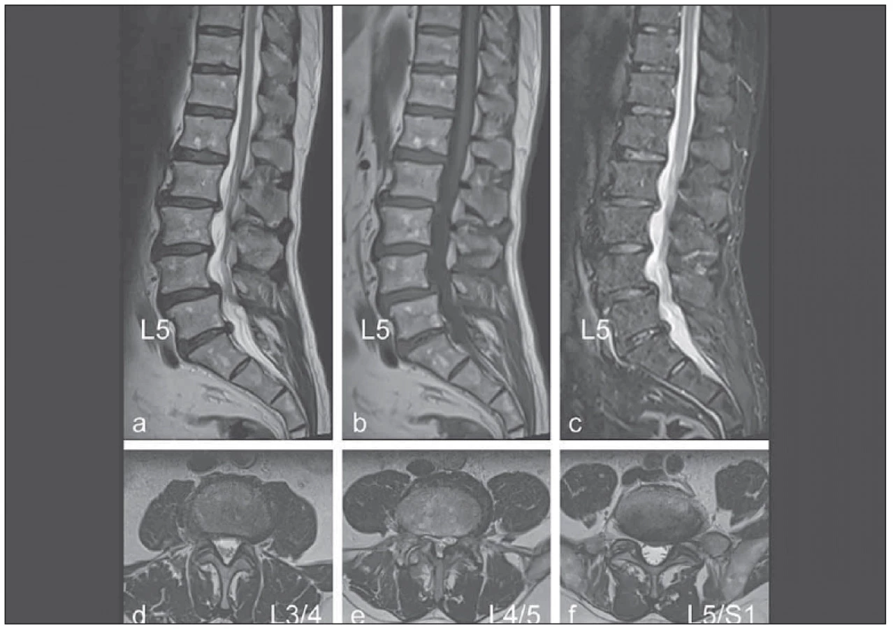 Lumbar spine disorder – the new occupational disease | proLékaře.cz