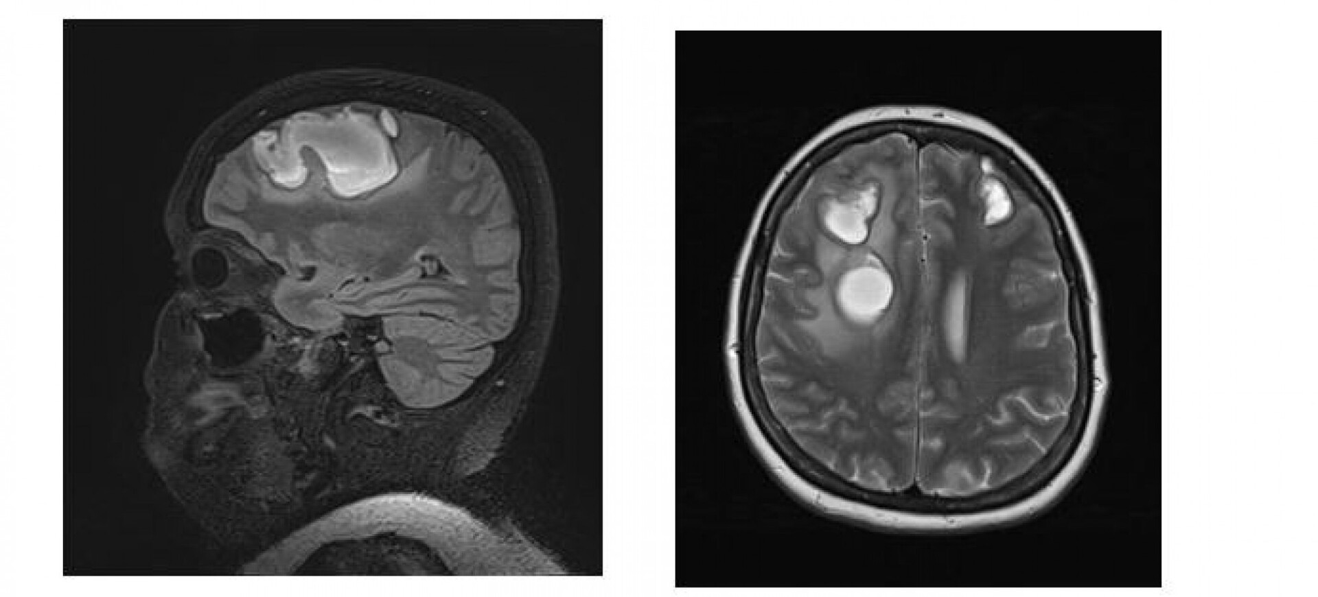 intracerebral-haemorrhage-in-covid-19-prol-ka-e-cz