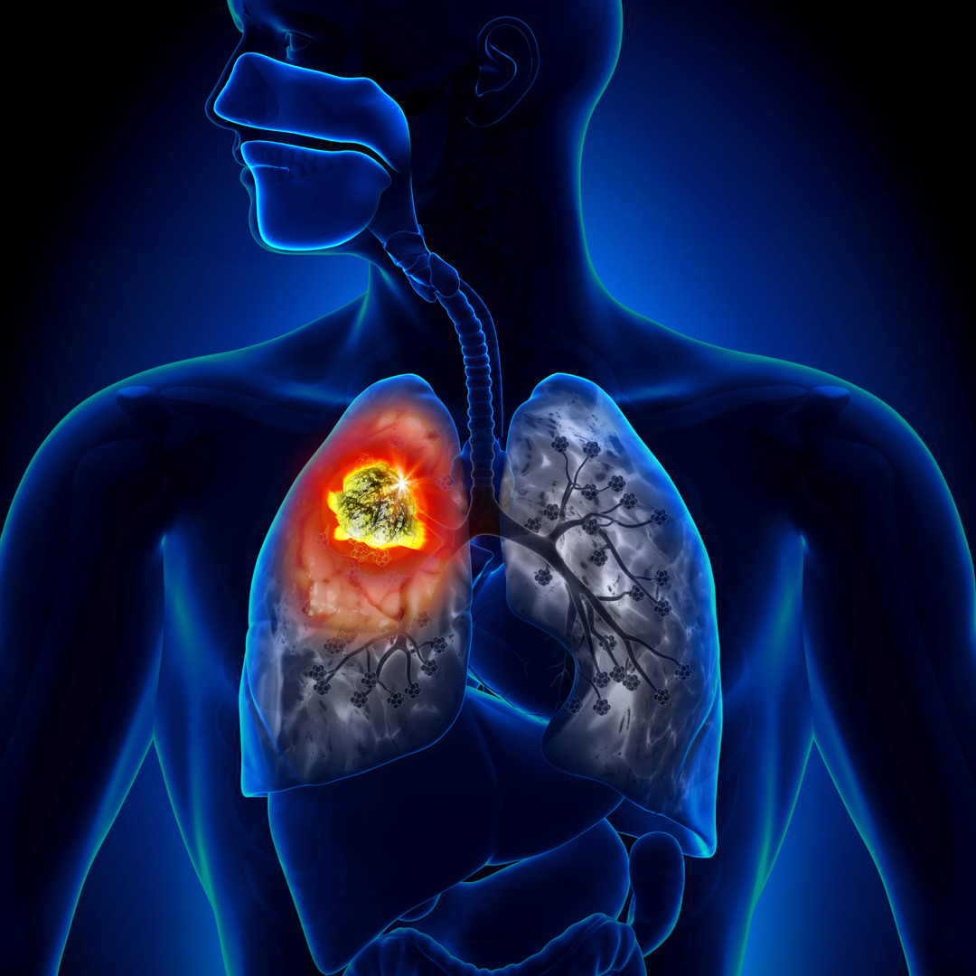 Change in Mutation Characteristics of NSCLC Detect... | proLékaře.cz