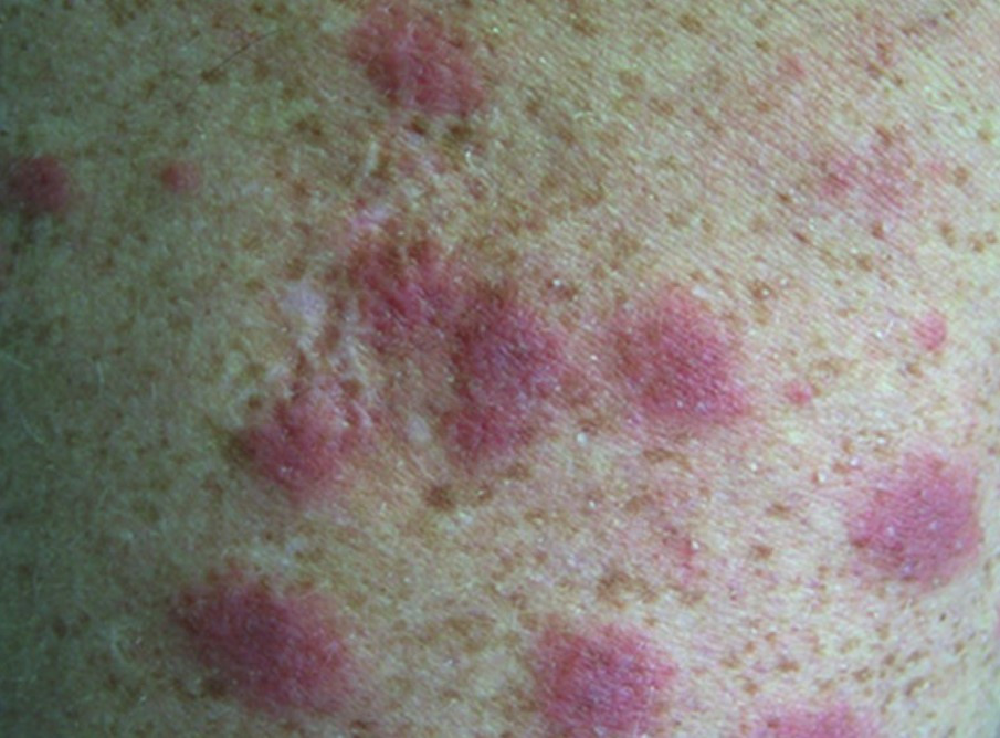 Acarodermatitis – Dermatitis Caused by Mites | proLékaře.cz